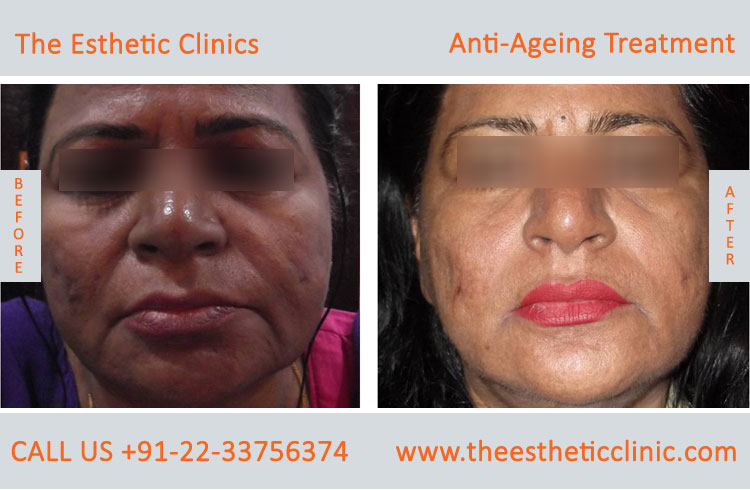 Anti Aging Treatment for Face Wrinkles before after photos in mumbai india (1 (11)